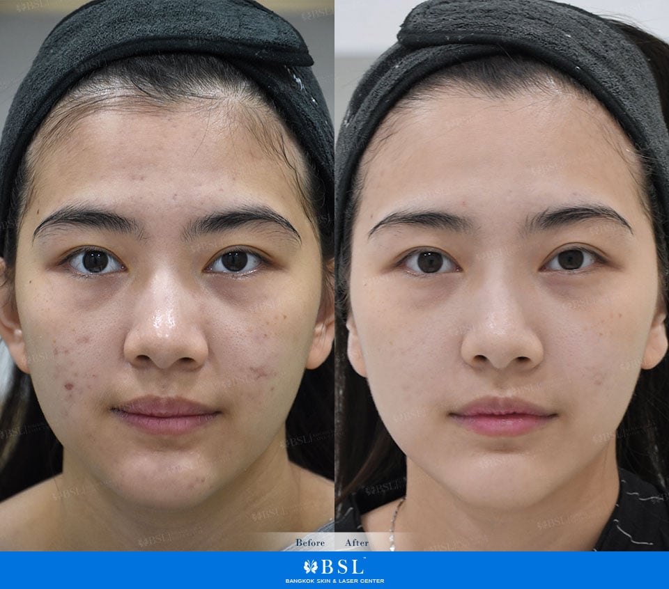 รีวิวเลเซอร์หน้าใส รีวิวผิวขาว จบปัญหาหน้าหมองคล้ำ จุดด่างดำ